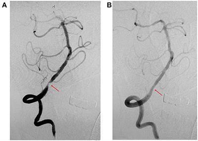 A Retrospective Study Comparison Between Stenting and Standardized Medical Treatment for Intracranial Vertebrobasilar Stenosis in a Real-World Chinese Cohort